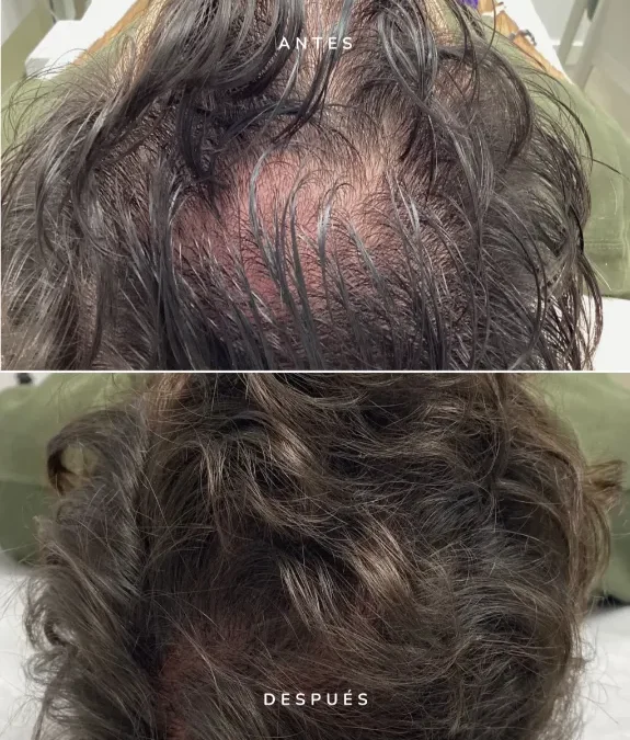 Dutasteride en mesoterapia: el aliado clínico que marca tendencia en salud capilar