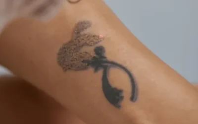 Eliminar un tatuaje ya no es un tabú: tecnología, estilo y nuevas oportunidades para tu piel